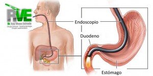 Porque-se-usa-la-endoscopia