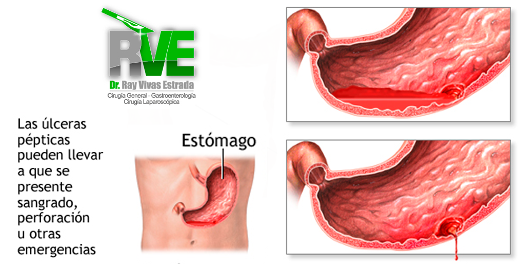 QuÉ Es Una Úlcera PÉptica Y QuÉ Afecta Dr Ray Vivas